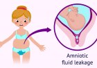 Leakage of amniotic fluid during pregnancy: Understand causes, symptoms and treatment
