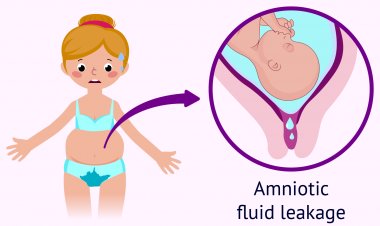 Leakage of amniotic fluid during pregnancy: Understand causes, symptoms and treatment