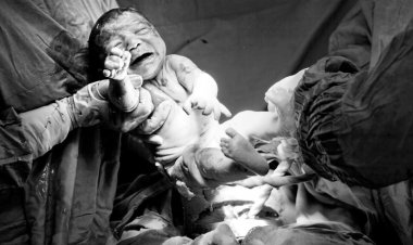 Everything you need to know about C-section