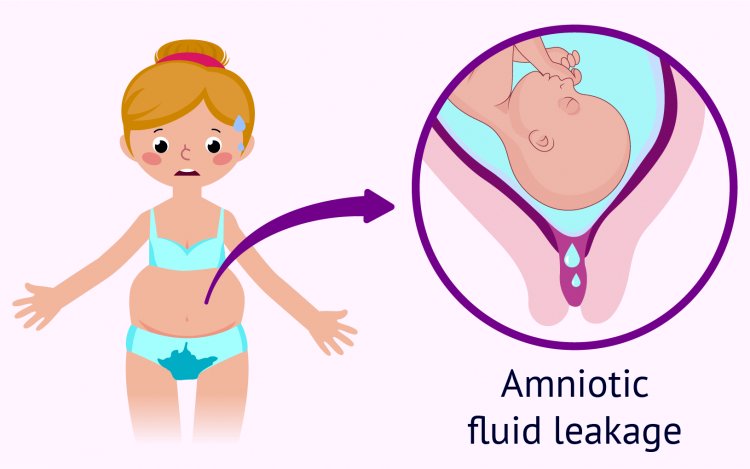 Leakage of amniotic fluid during pregnancy: Understand causes, symptoms and treatment